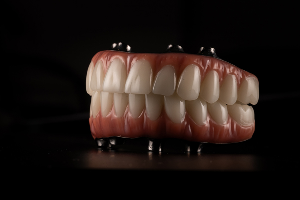 The Advantages Of Implant Supported Dentures Over Regular Ones